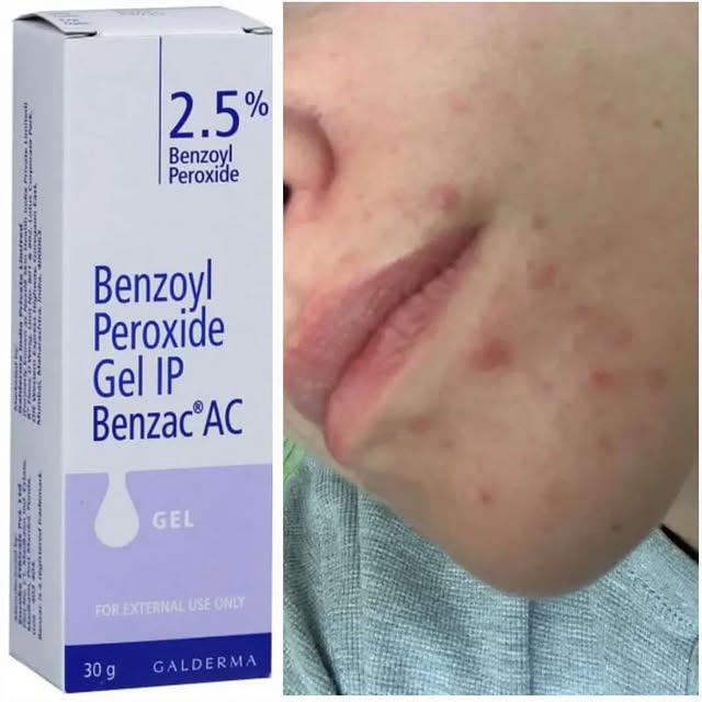 Takeer - Benzoyl peroxide gel ip 2.5
Available Price 35,000 
Tiba ya chunus hii ya uhakika