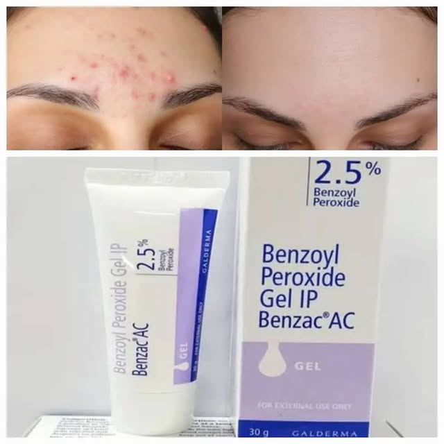 Takeer - Benzoyl peroxide gel ip 2.5
Available Price 35,000 
Tiba ya chunus hii ya uhakika