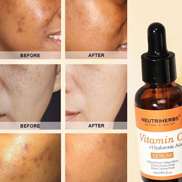 Takeer - Vitamin c serum za neutriherbs zipo dukani hizi ni nzuri snaa kwa kusoftisha ngozi,kuondoa madoa. Chunusi na kukupa ngozi nzuri snaa yani mtelezo h...